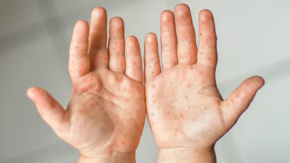 Meningitis Typ B: Symptome, Risiken und Verlauf in Deutschland 2026