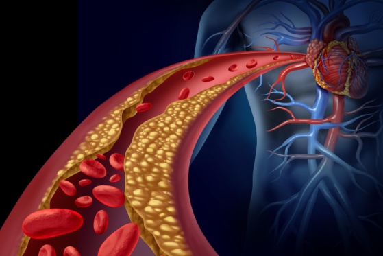 Hoher Cholesterinspiegel: Diagnose, Symptome und was Betroffene jetzt tun sollten