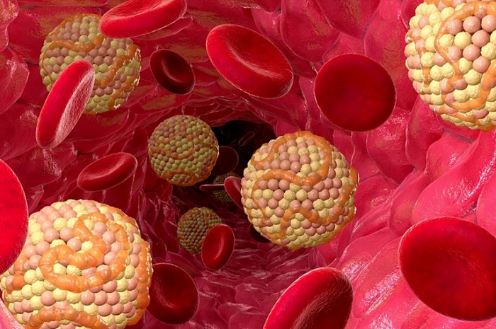 Hoher Cholesterinspiegel: Diagnose, Symptome und was Betroffene jetzt tun sollten