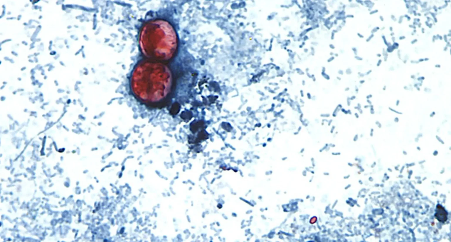 Parasiten-Ausbruch in den USA: Wie groß ist die Gefahr für Deutschland?