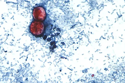 Parasiten-Ausbruch in den USA: Wie groß ist die Gefahr für Deutschland?