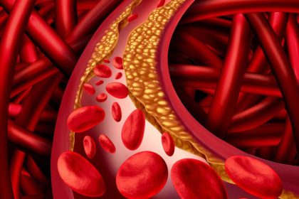 Hoher Cholesterinspiegel: Diagnose, Symptome und was Betroffene jetzt tun sollten