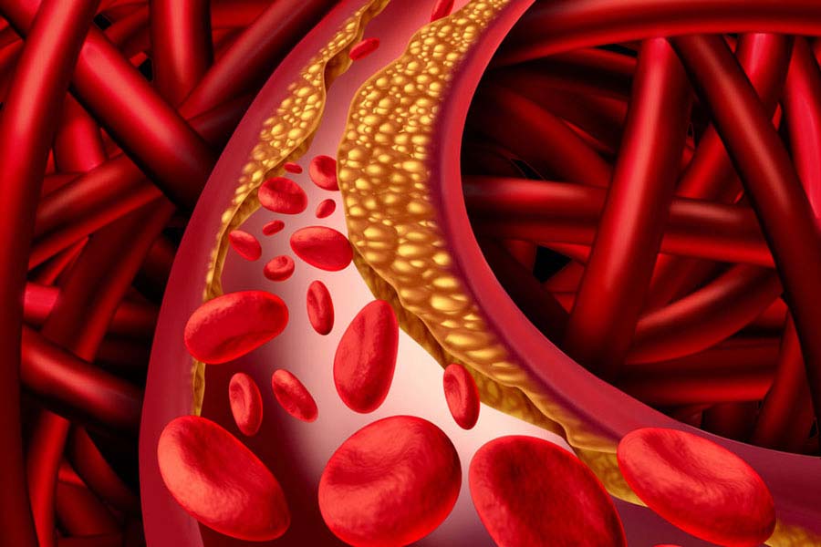 Hoher Cholesterinspiegel: Diagnose, Symptome und was Betroffene jetzt tun sollten