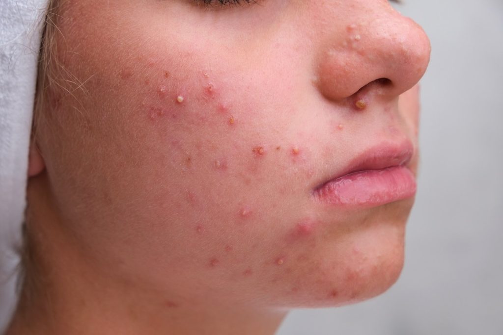 Akne-Mittel Isotretinoin 2026 knapp: Was hinter dem Microdosing-Trend steckt