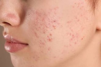Akne-Mittel Isotretinoin 2026 knapp: Was hinter dem Microdosing-Trend steckt