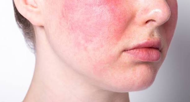Akne-Mittel Isotretinoin 2026 knapp: Was hinter dem Microdosing-Trend steckt